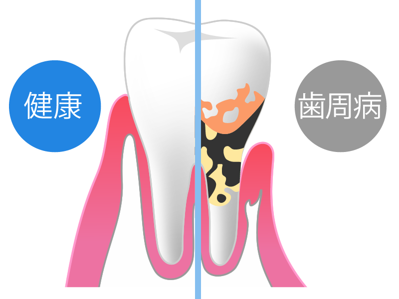 歯周病の基礎知識